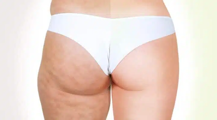 Tipps Gegen Cellulite