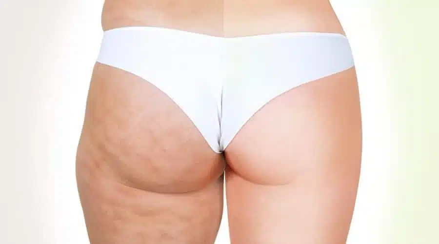 Tipps Gegen Cellulite