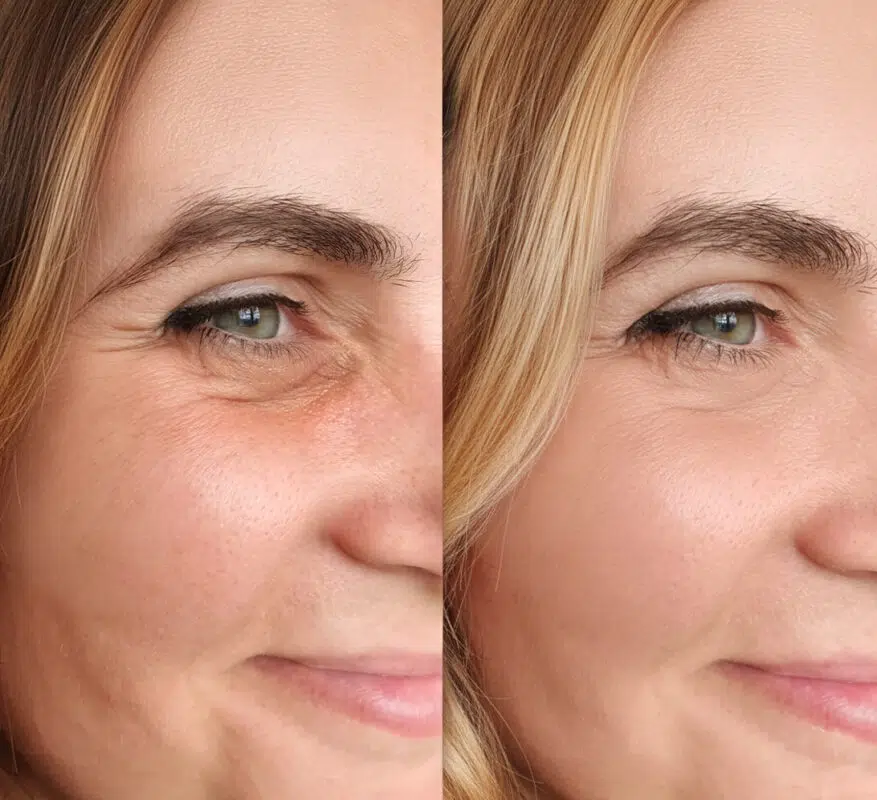 Collagen vorher nachher